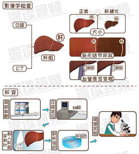 肝硬化的最重要的并发症_宋小宝肝硬化严重程度(美女厨房袁咏仪)